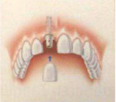 Eine Implantatgetragene Krone